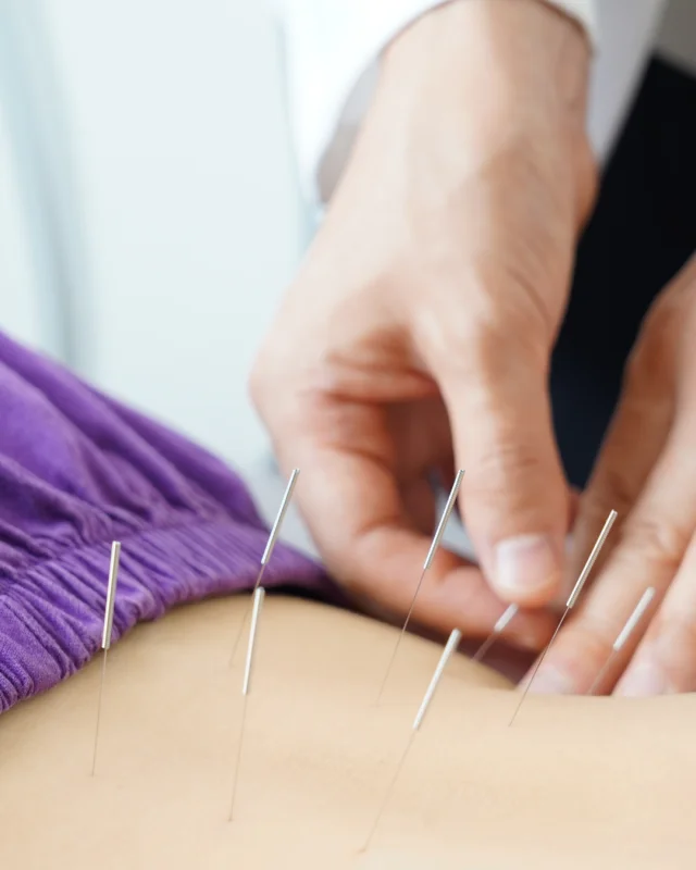 acupuntura