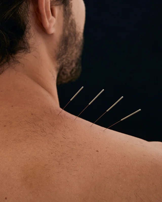 acupuntura