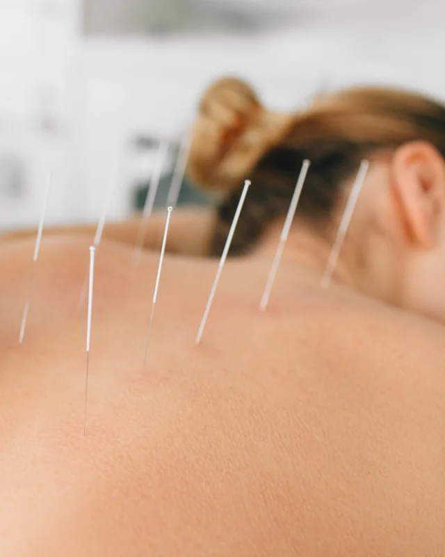 acupuntura
