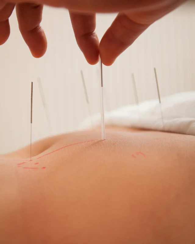 acupuntura chinesa