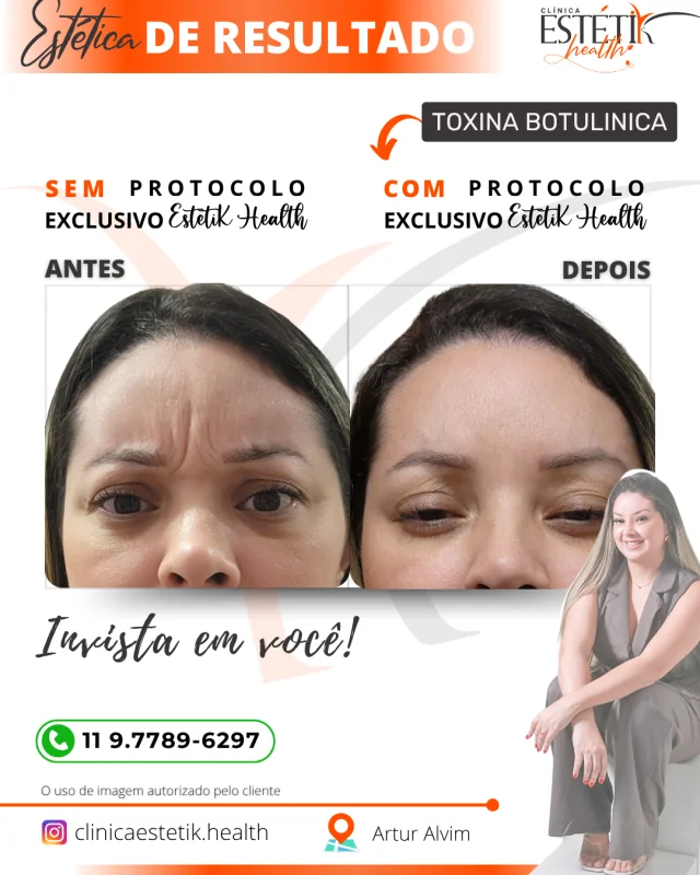 aplicação de botox