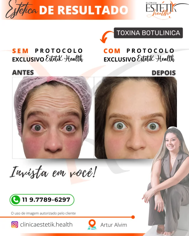 aplicação de botox