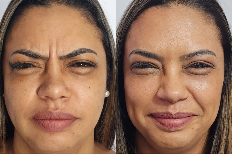 aplicação de botox