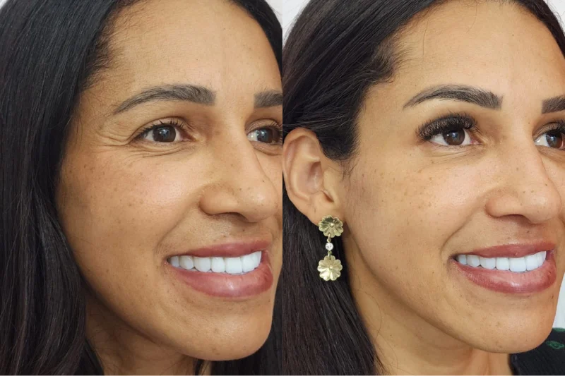 aplicação de botox