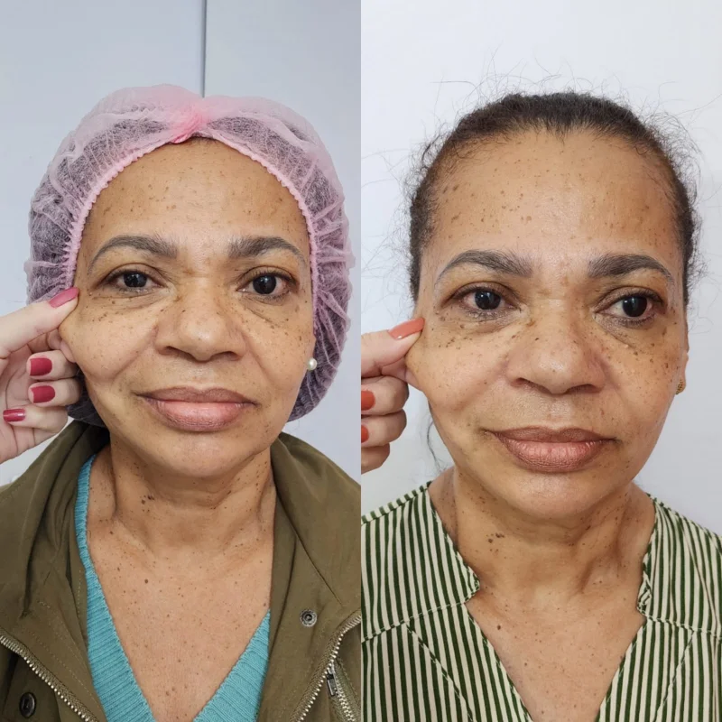 bioestimulador para flacidez corporal