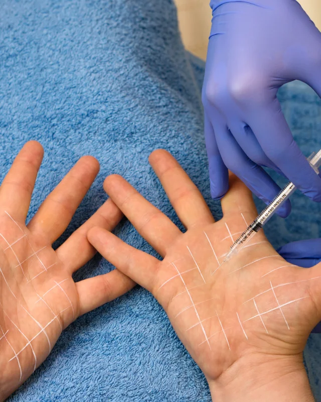 botox facial