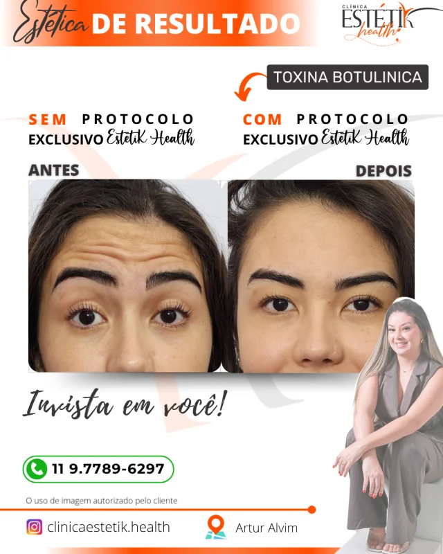 botox facial masculino
