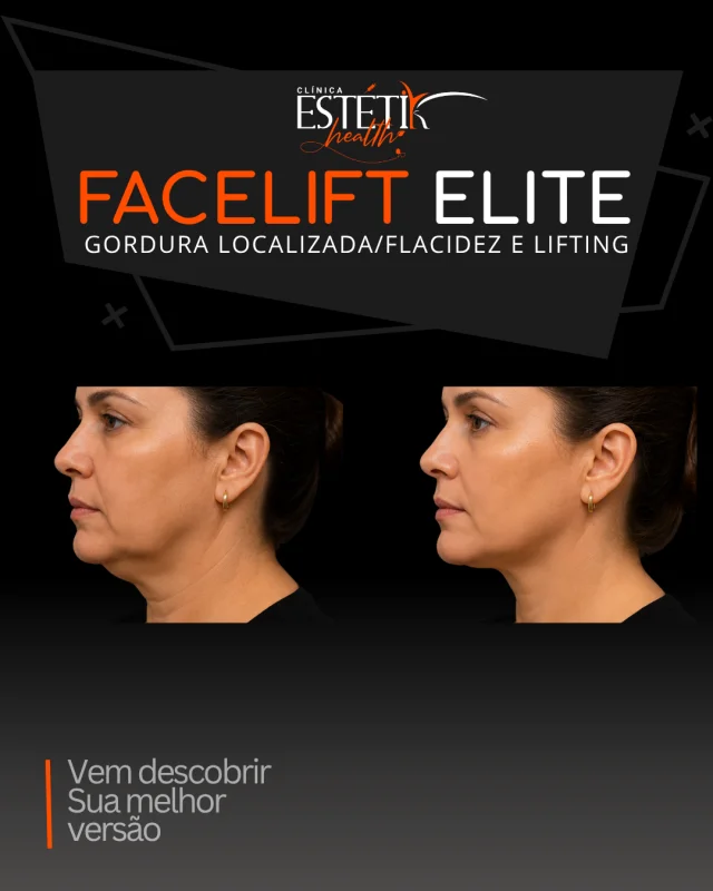 endolift
