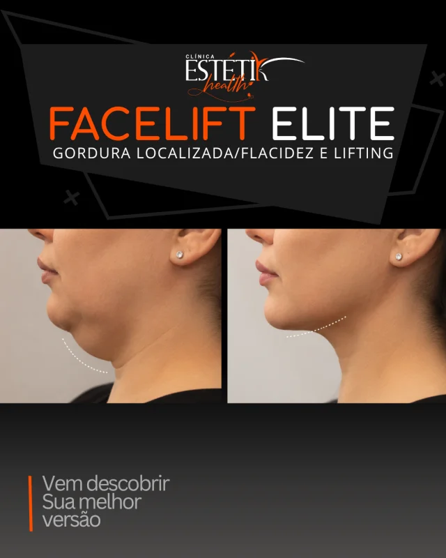 endolift