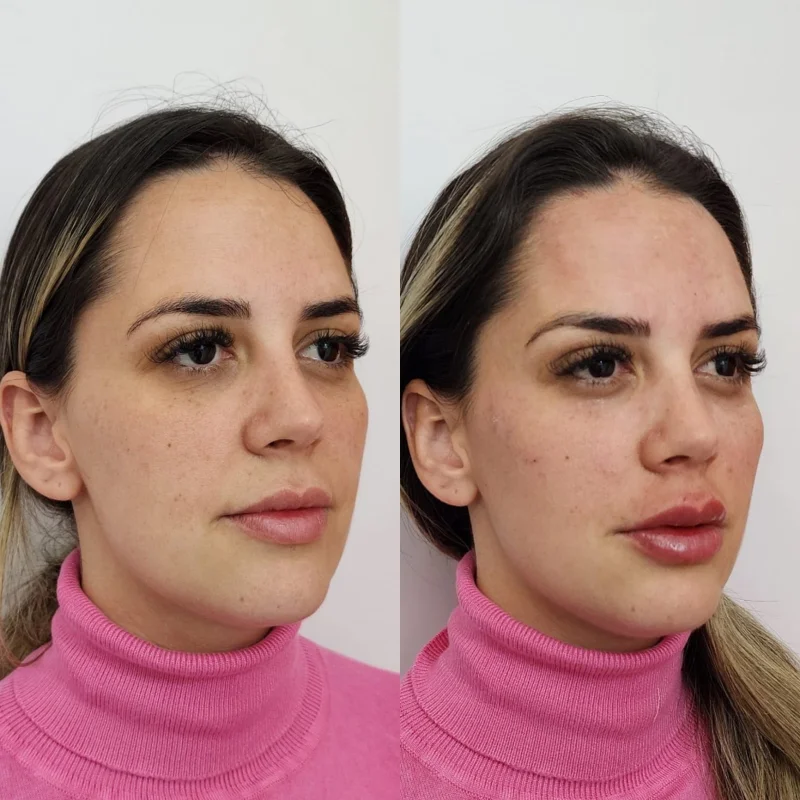 harmonização de rosto
