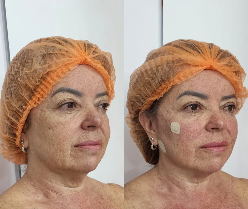 harmonização full face