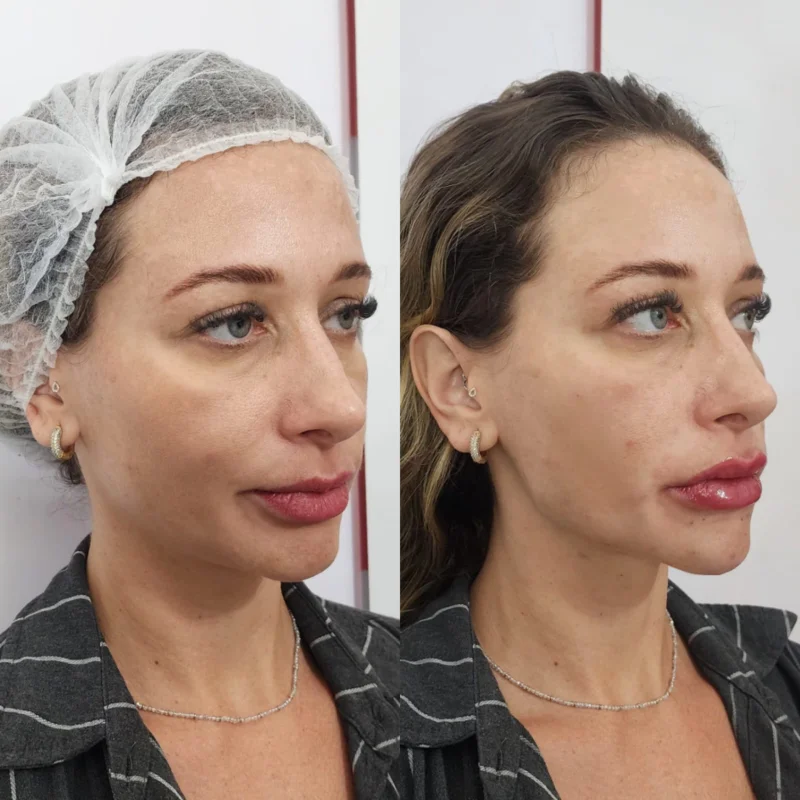 harmonização full face