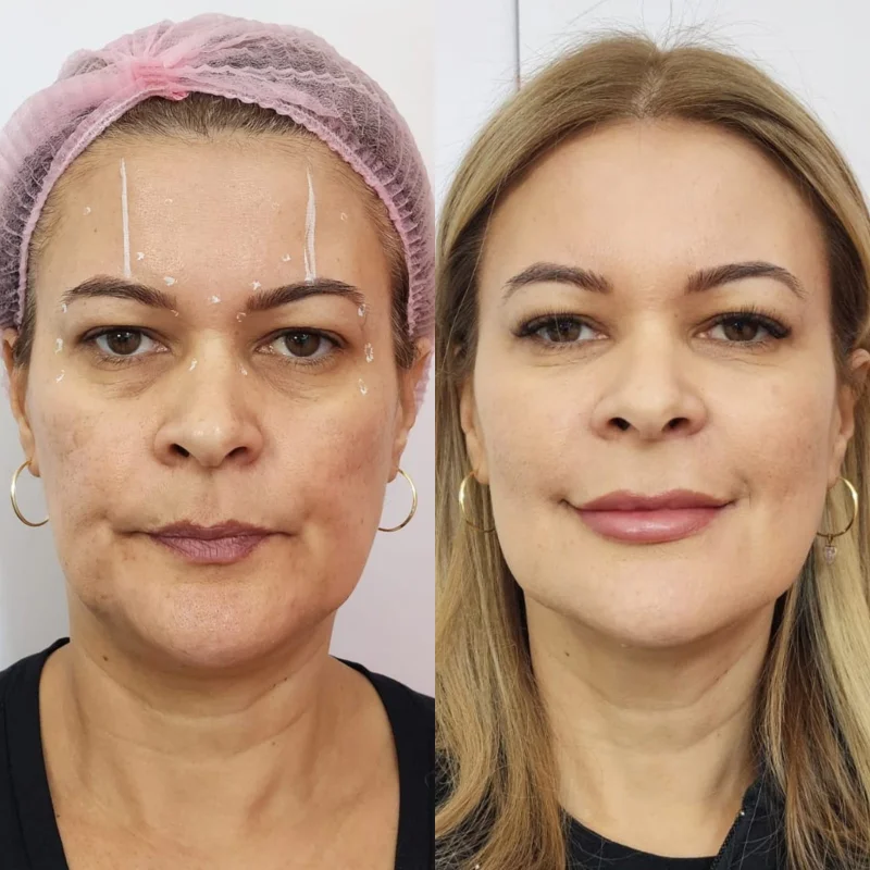 harmonização full face