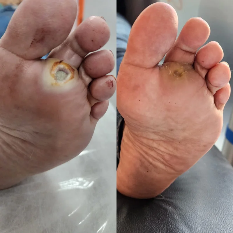ozonioterapia
