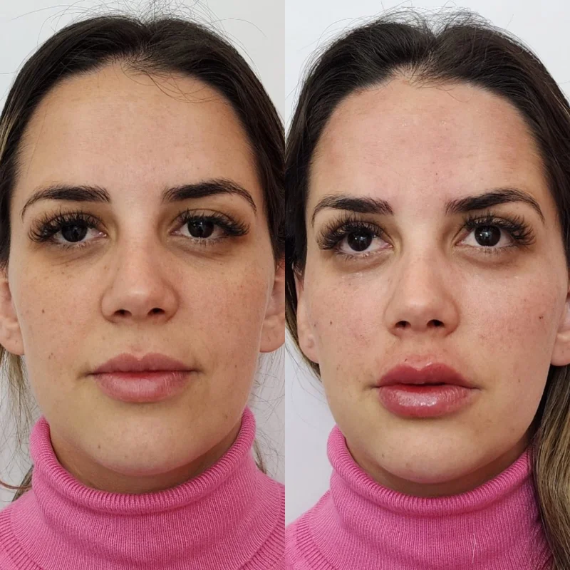 perfiloplastia com acido hialuronico