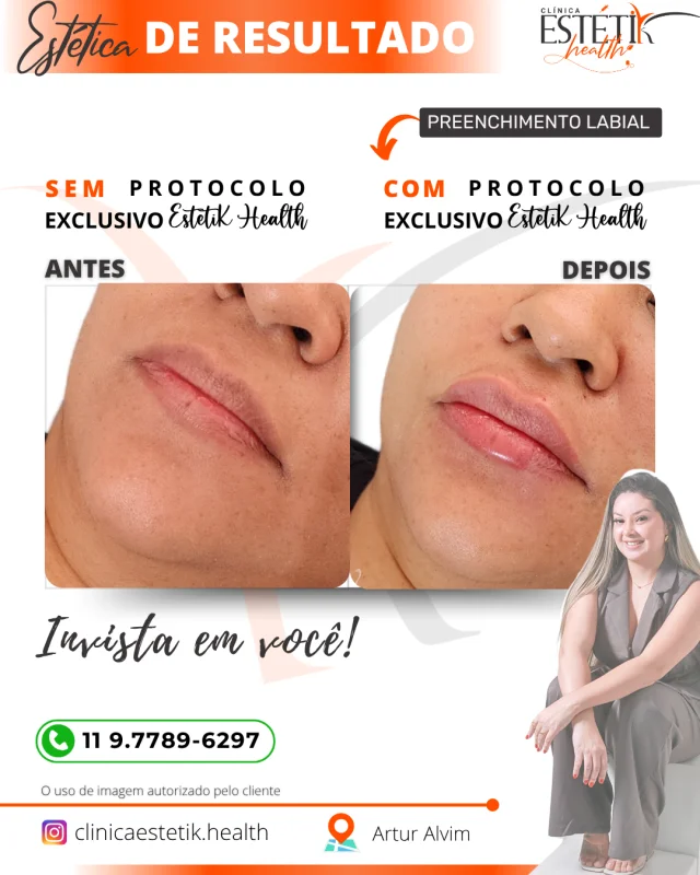 preenchimento labial