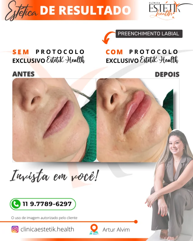 preenchimento labial