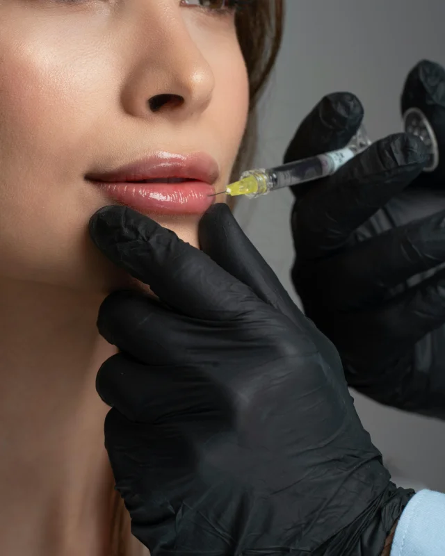 preenchimento labial com ácido hialurônico