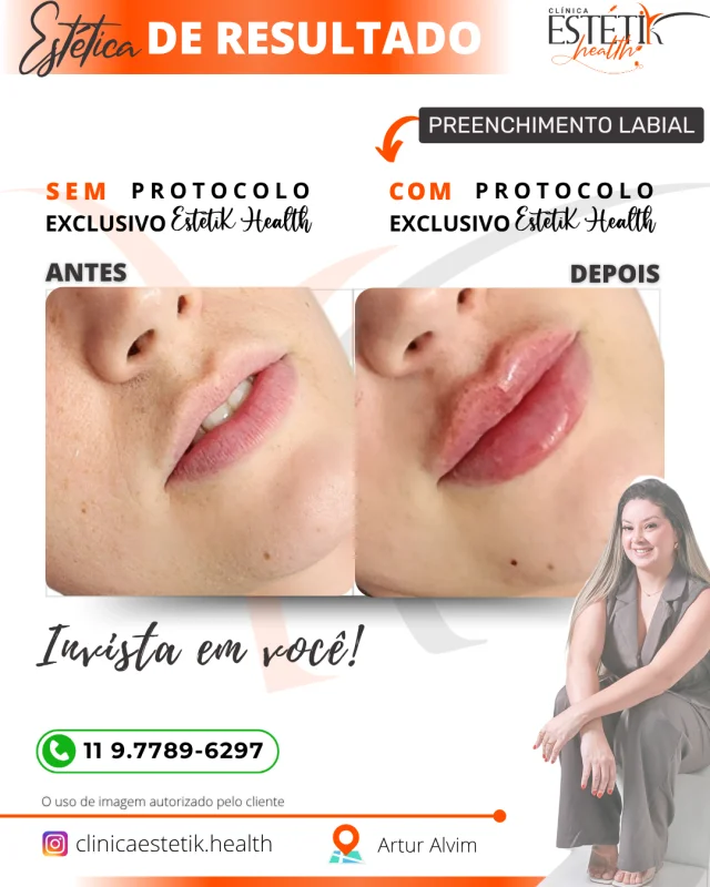 preenchimento labial com ácido hialurônico na Vila Formosa