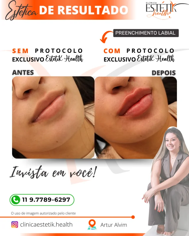 preenchimento labial em Aricanduva