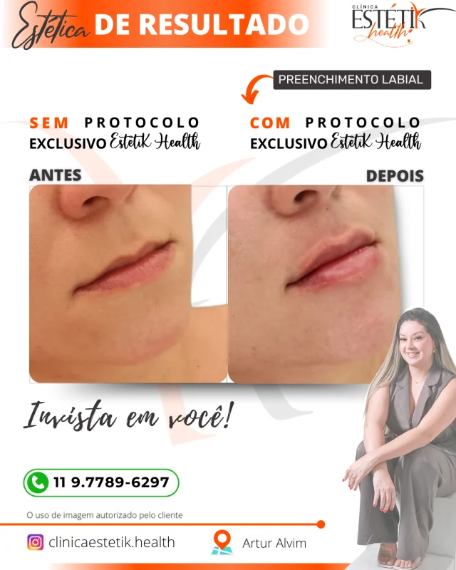 preenchimento labial em Aricanduva
