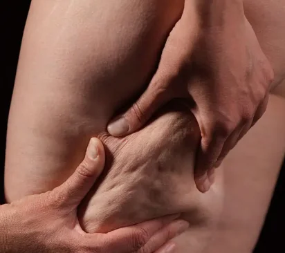 Tratamento para Lipedema