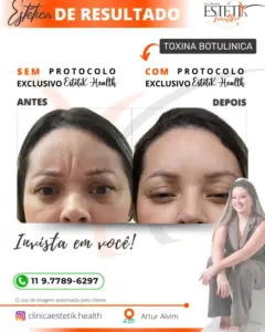 Tóxina Botulínica