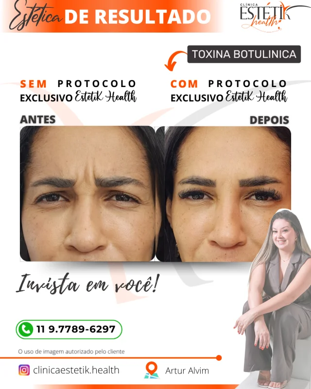 toxina botulínica em Aricanduva
