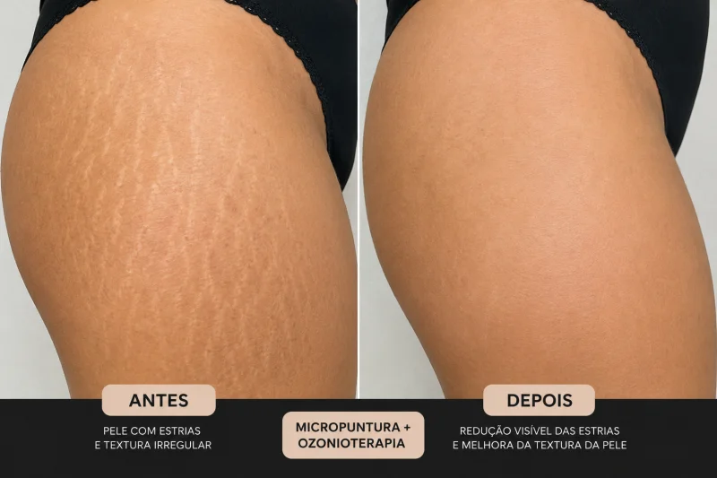 tratamento a laser para estrias