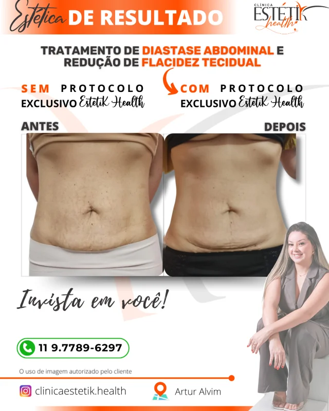 tratamento de melasma