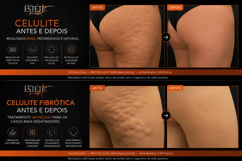 tratamento para celulite