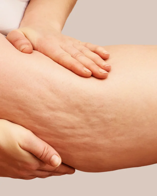 tratamento para lipedema