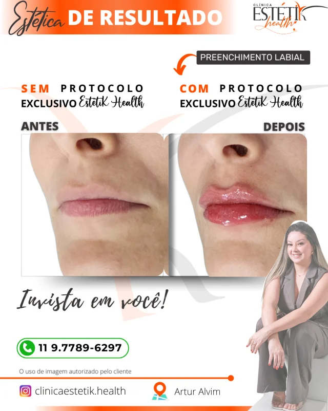 volumização labial